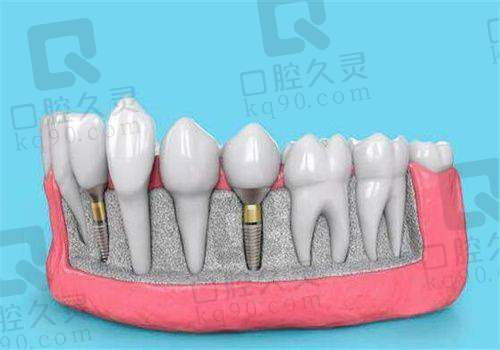种牙什么牌子的性价比更高：瑞典诺贝尔