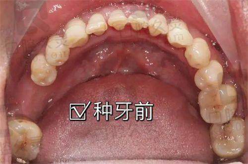 种牙什么牌子的性价比更高：国产登腾