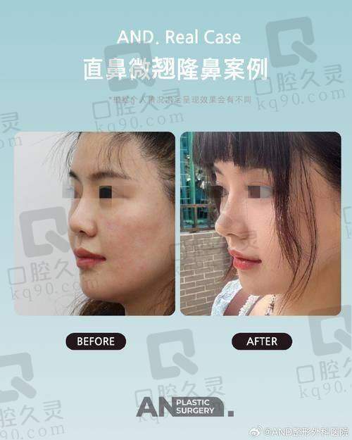 耳软骨双侧和单侧有什么区别之材料来源