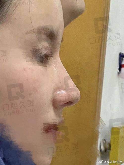 耳软骨双侧和单侧有什么区别之医生的建议