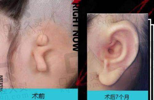 泰国去势手术价格梯度及细分项目价格