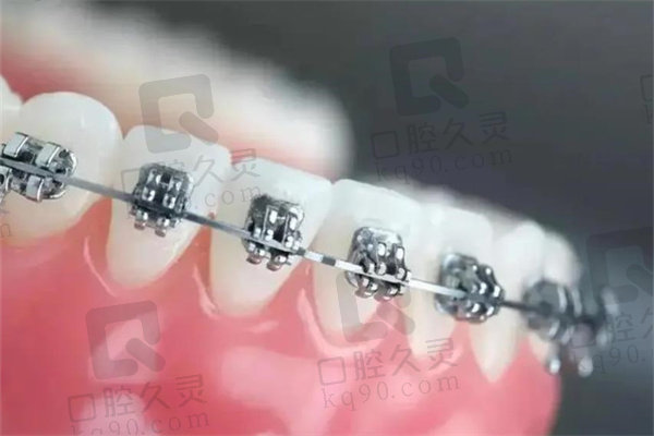 广州穗华口腔医院龅牙金属自锁托槽矫正分享：从自卑龅牙妹到自信微笑女神的逆袭之旅