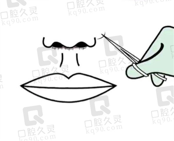 北京画美马群做唇价格多少？唇腭裂5万、M唇8千、人中缩短9千起性价比高