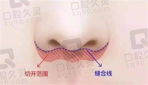 深圳福雅医疗美容正规吗？胡俊杰医生人中缩短术效果如何？真人案例揭秘