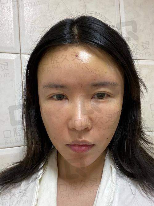 五、真实实例见证冯斌脂肪填充的神奇