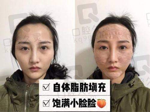四、冯斌自体脂肪填充价格分析