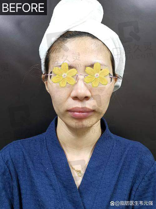 二、冯斌脂肪填充存活率大揭秘
