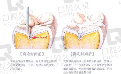 厦门麦芽口腔儿童窝沟封闭项目有什么优势？