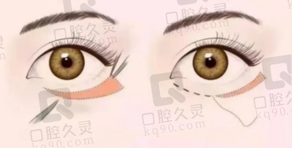 淄博壹美整形外切祛眼袋3000元起，有效解决松弛型眼袋，重塑眼部年轻态！