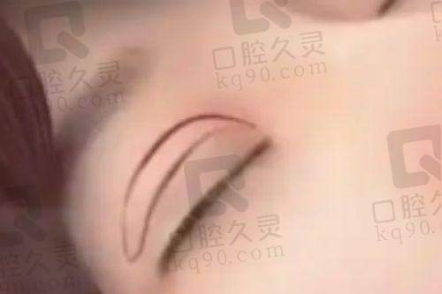 徐淑卿医生曼托假体隆胸成功实例分享