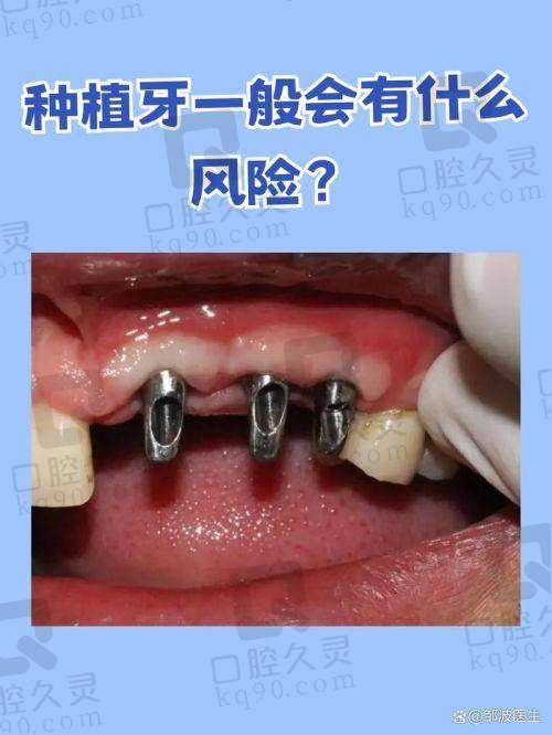 深圳正恩口腔是三甲嗎？2025種牙1500元起全包正規連鎖靠譜