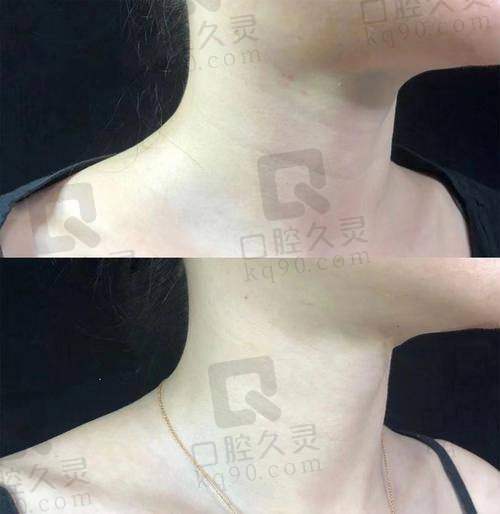 五、颈纹改善的正确心态与方案调整