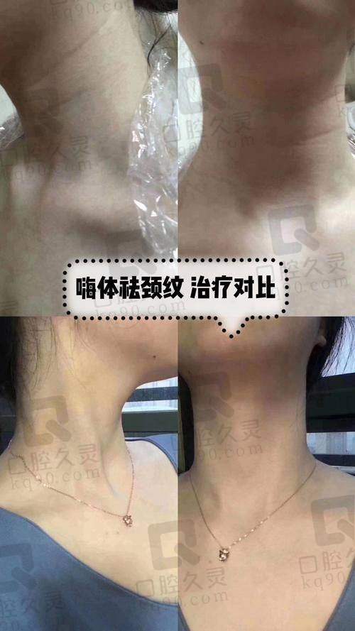 三、医美手段去颈纹