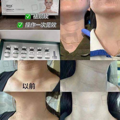 二、日常护理去颈纹
