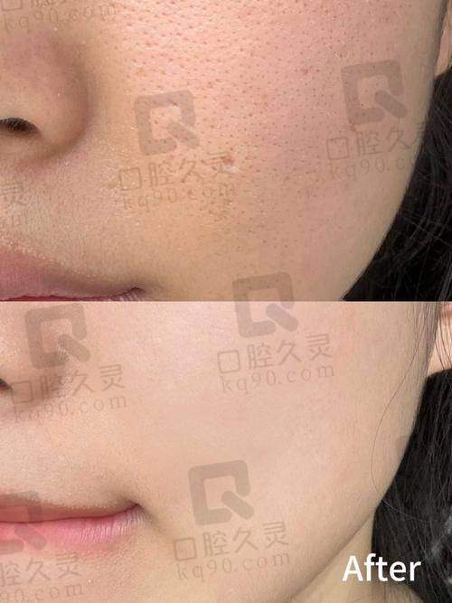 乌鲁木齐华美整形4代半岛黄金微针价格1299元起，祛痘缩孔抗皱一步到位超划算