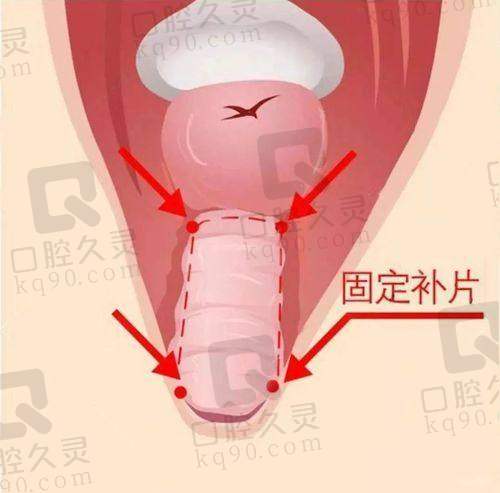 广州建国医院的阴道紧缩术有哪些技术优势？