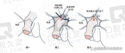 广州建国医院阴茎延长术体验：效果显著重拾自信，手术过程安全又贴心 