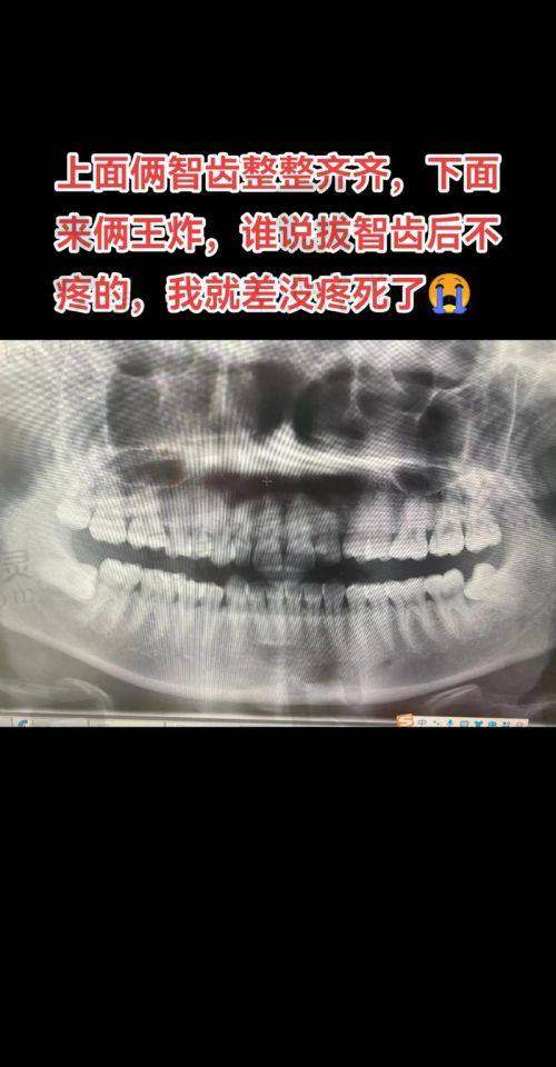 东莞国贸口腔疑难阻生智齿拔除价格980元起一颗，先进技术助你无痛轻松拔牙