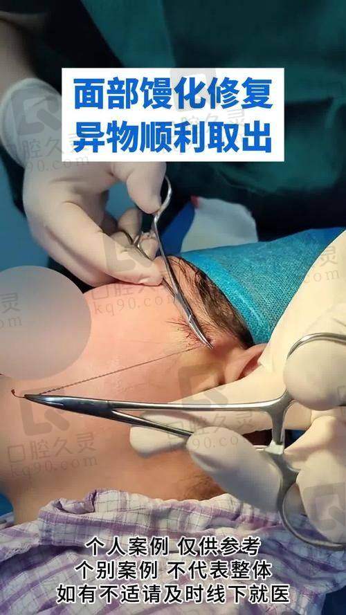 广州荔医余东文做馒化脸修复超神，仅花这个价就重获自然美脸！
