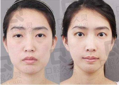 嘉兴曙光整形医院双眼皮手术的成效怎么样？