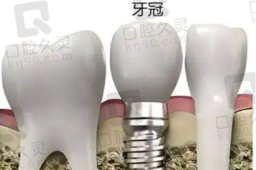 郭晓东种植牙实例