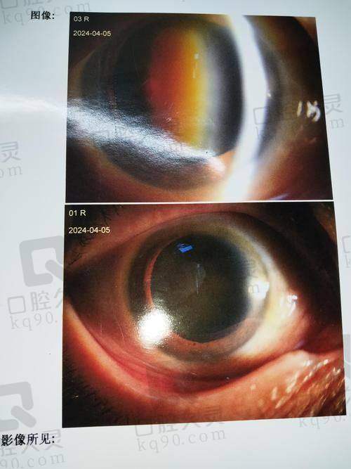 临汾洛基眼科医院白内障费用多少？2500元起价格透明，诊疗靠谱有保障 