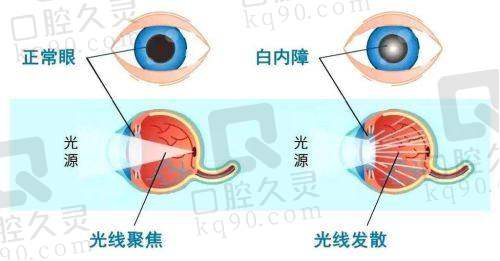 选择临汾洛基眼科医院治疗白内障的优势总结