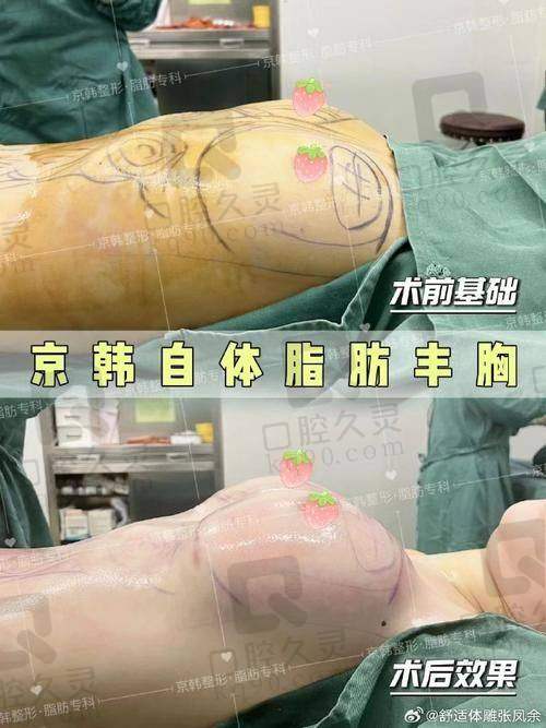 广州军美整形医院自体脂肪丰胸成效好吗？更终成效呈现