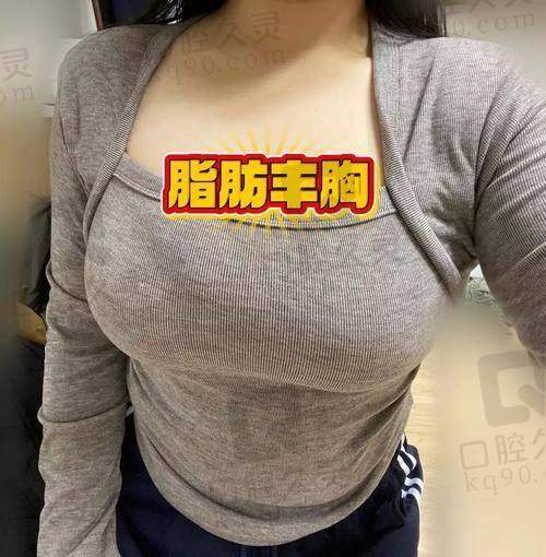 广州军美整形医院自体脂肪丰胸体验，饱满胸部自然柔软，术后恢复轻松效果超赞 