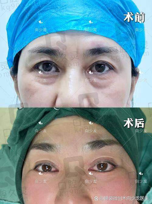 深圳朱冠峰“7D祛眼袋”是什么？不开刀、无淤青成较大卖点