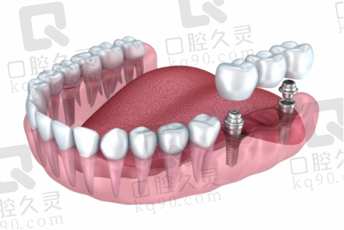 安装牙冠的过程是怎样的？