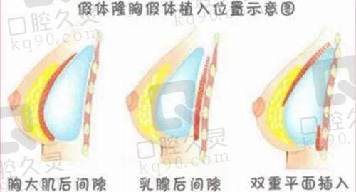 张永医生做双眼皮的技术有哪些特点？