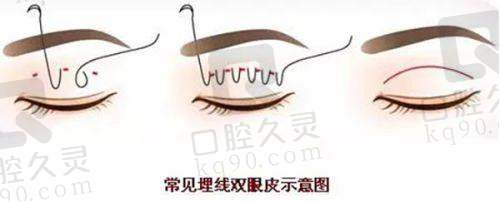 脸型的蜕变：从“大方脸”到“小V脸”