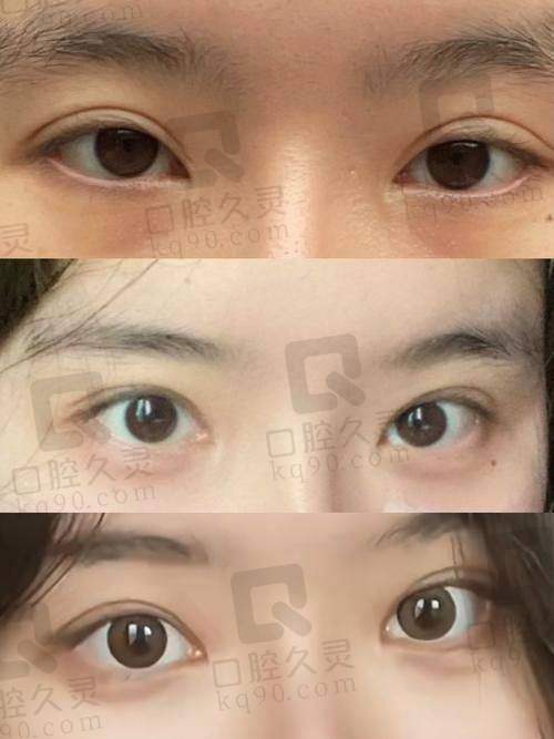 上海九院割双眼皮医生怎么选？苏薇洁、朱海男等医生技术精湛审美在线！ 