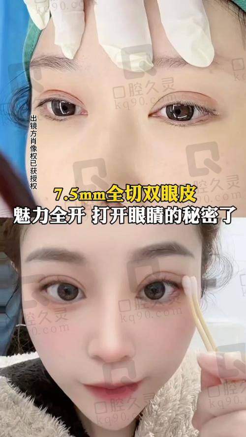 朱海男医生：拥有欧美风理念的眼部骨干医生