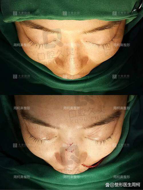 上海华美李健医生修复鼻子怎么样?要多少钱?脊状肋软骨+3D数字化技术,鼻修复3万起|隆鼻5万起
