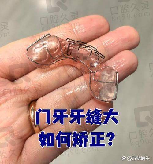 牙齿矫正的成效如何？我有什么感受？