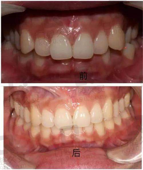 北京正畸徐宝华和张栋梁:临床成效硬碰硬,数据说话更靠谱