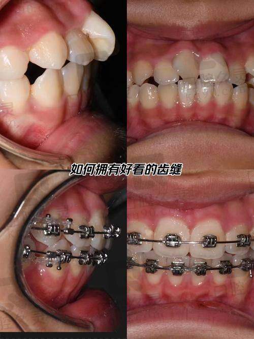 【北京正畸徐宝华和张栋梁哪个更好？】2025：徐宝华舌侧强|张栋梁方案牛！