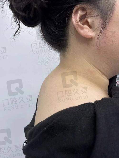 广州丽合医疗美容医院戚昌栋医生的眼整形技术