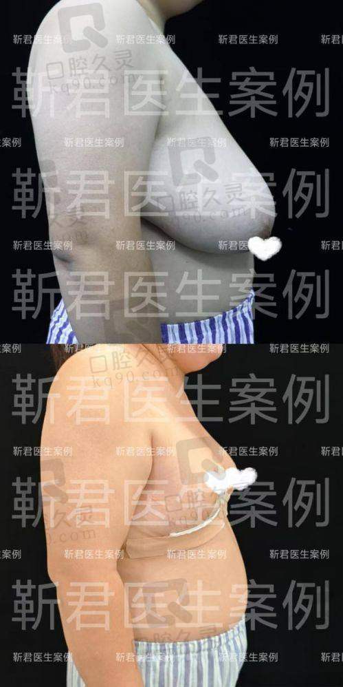 武汉做的乳房提升要多少钱？这些“隐形消费”要避开！