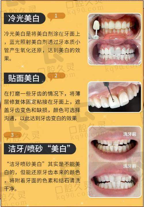 牙齿美白后的成效和感受如何？