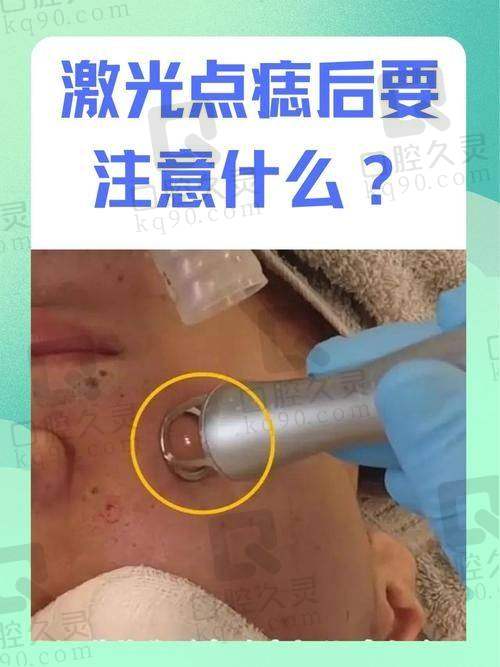 有去南京美莱整形美容医院过激光点痣的吗？满脸黑痣靠这招轻松说拜拜