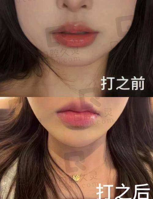 瘦脸针的成效怎么样？