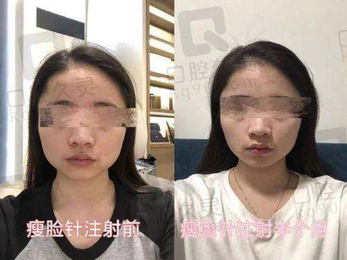 瘦脸针价格贵不贵？