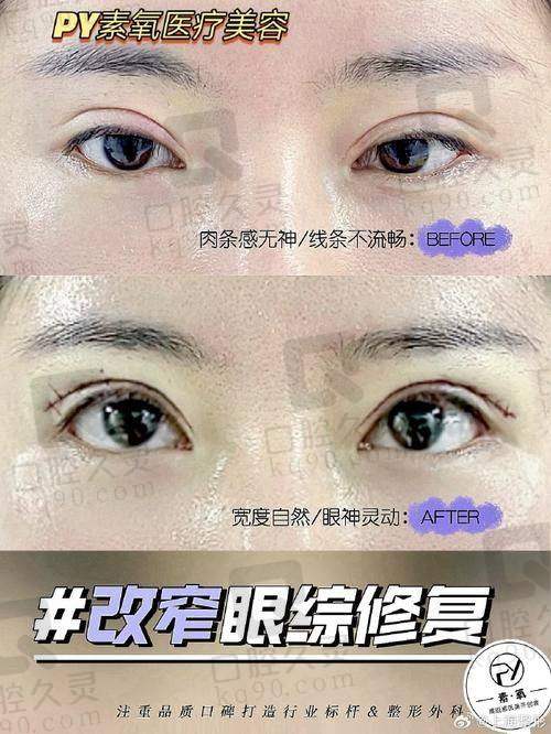 广州海峡整形医院全切双眼皮技术特色