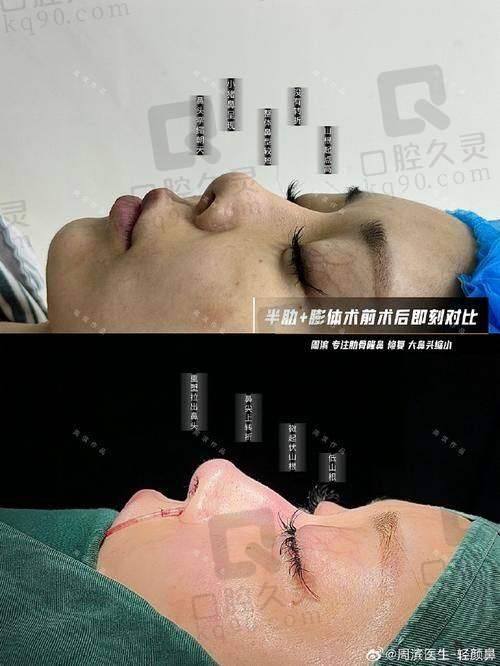 鼻综合整形手术过程是怎样的？