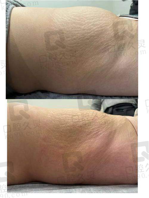 吸脂修复怎么样？多久能消肿、正常生活？