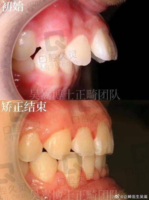 总结：南昌虹桥口腔医院牙齿矫正之旅的收获