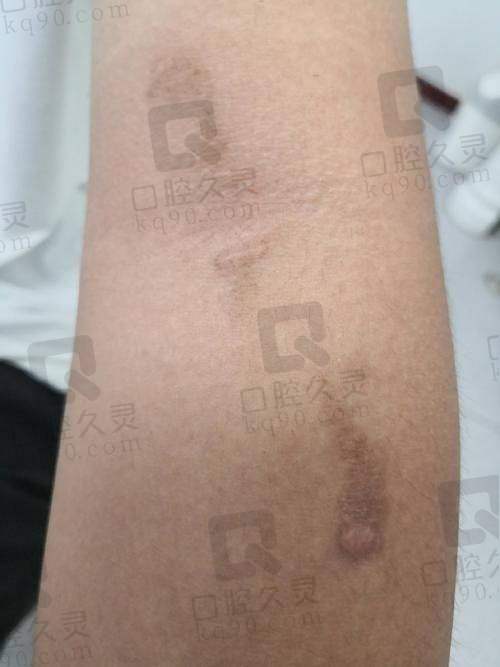 昆明华美美莱祛斑怎么样：激光魔法开启治疗之旅